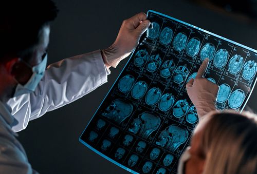 CBD e Epilepsia: uma nova esperança para o controle das crises