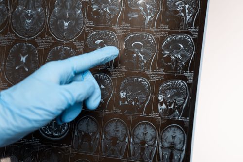 Cannabis e Esclerose Múltipla: o que a ciência já descobriu sobre essa aliança terapêutica